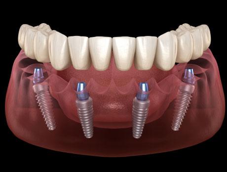 4 Implants